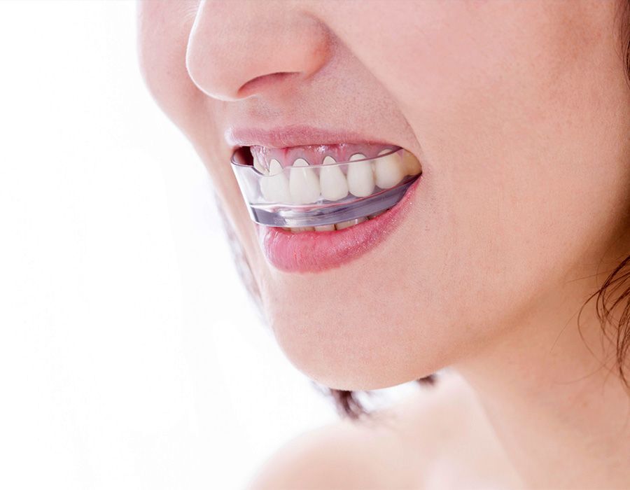 Un primer plano de la boca de una mujer con aparatos dentales.