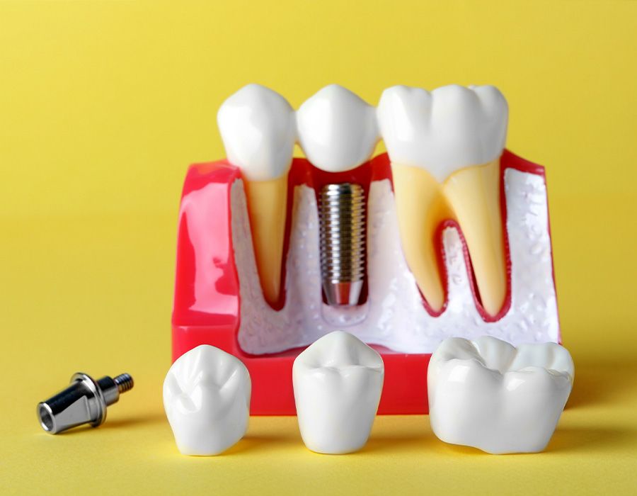 Un modelo de un implante dental entre dos dientes sobre un fondo amarillo.