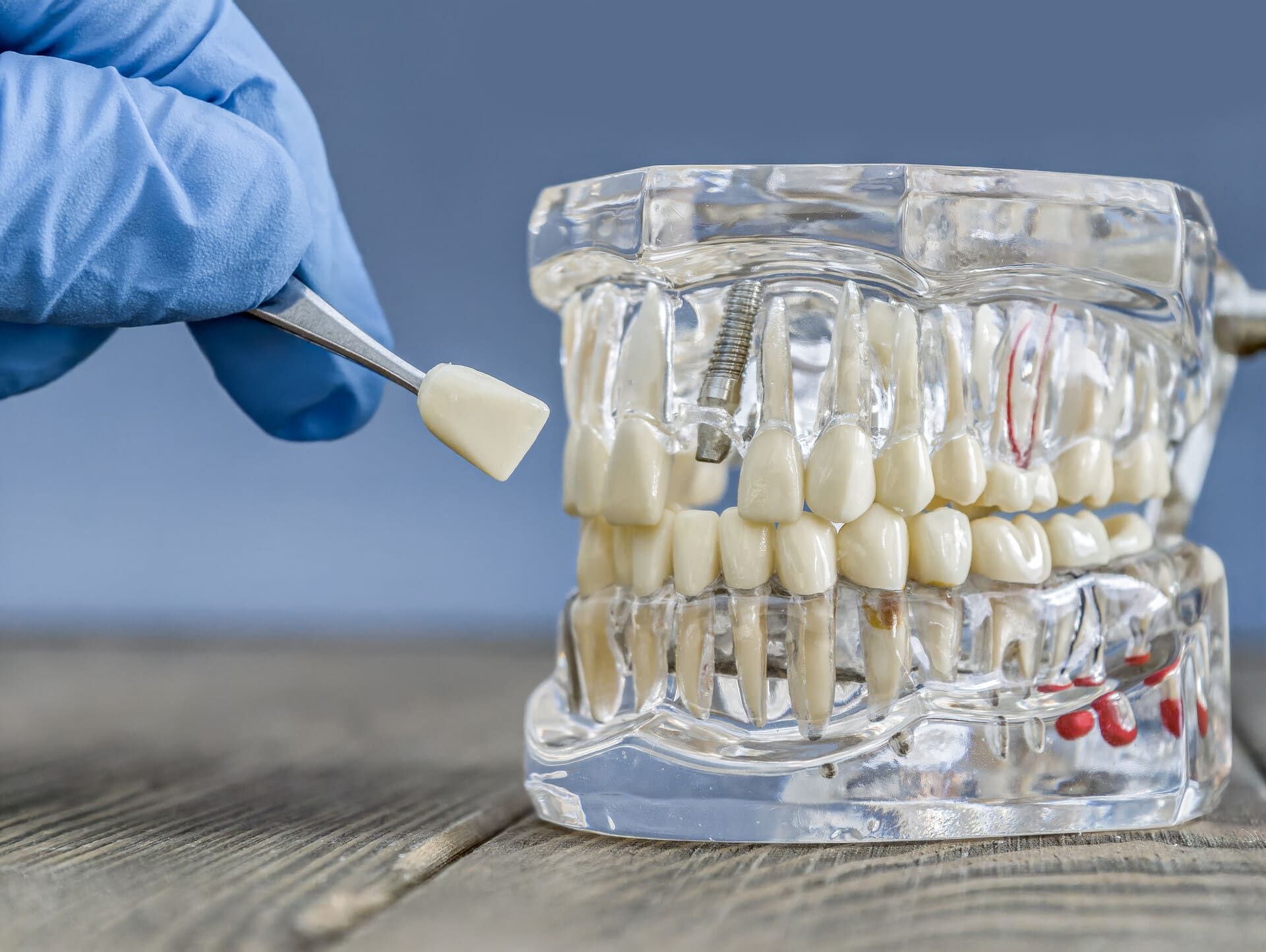 Un par de dentaduras postizas están colocadas sobre una superficie blanca.