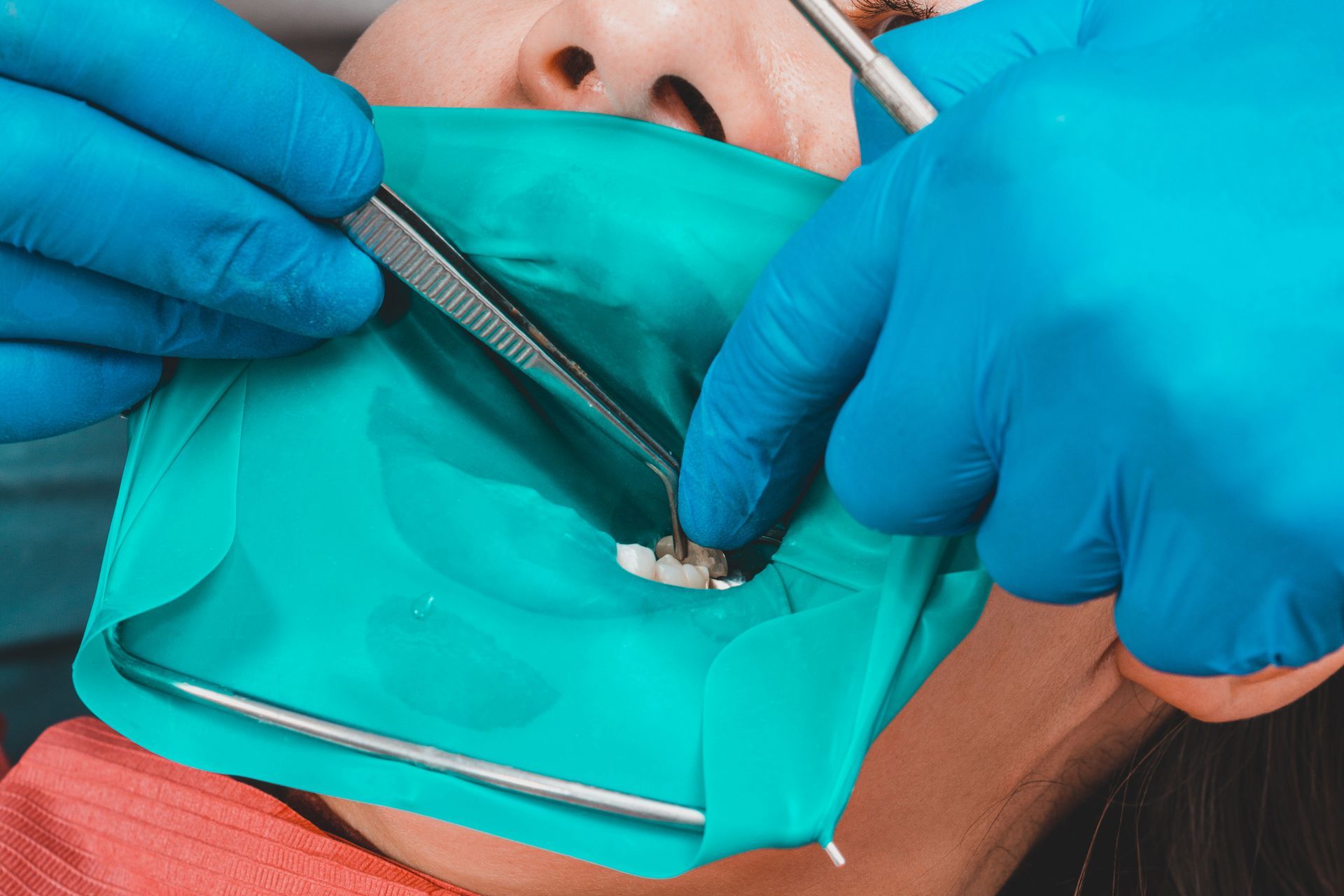 Trabajo dental: Manos enguantadas del dentista utilizando pinzas en un diente, dentro de un dique de goma.