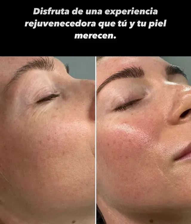 A before and after photo of a woman 's face with the caption disfruta de una experiencia rejuvenecedora que tu y tu piel merecen