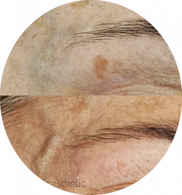 Una foto de antes y después del rostro de una mujer con la palabra estética escrita en la parte inferior.