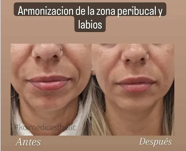Una foto de antes y después del rostro de una mujer con el título Armonización de la zona peribucal y labios.
