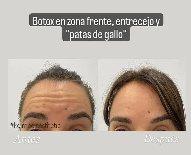 Una foto de antes y después de la frente de una mujer.