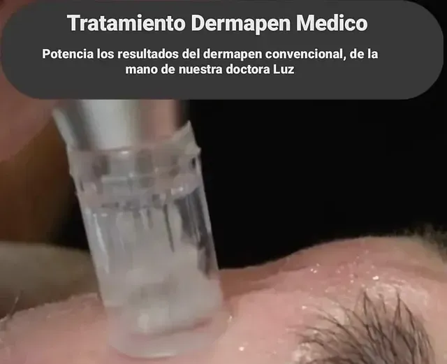 Una persona que recibe un tratamiento con Dermapen Medico en la cara.
