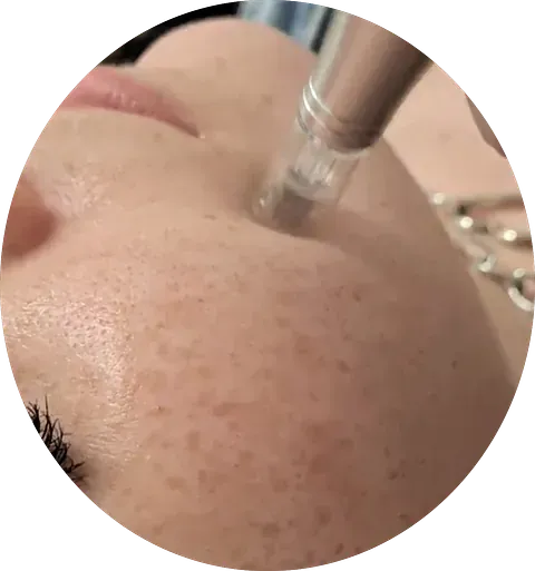 Un primer plano del rostro de una mujer con una aguja clavada.