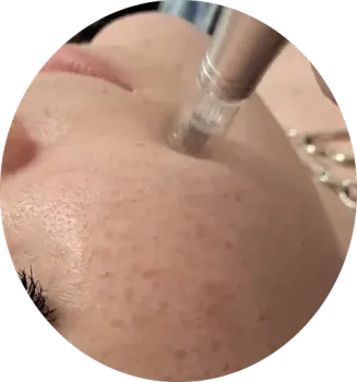 Un primer plano del rostro de una mujer con una aguja clavada.
