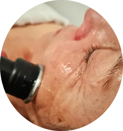 Una mujer está recibiendo un tratamiento en su cara.