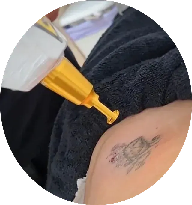 Una persona se está quitando un tatuaje del brazo.