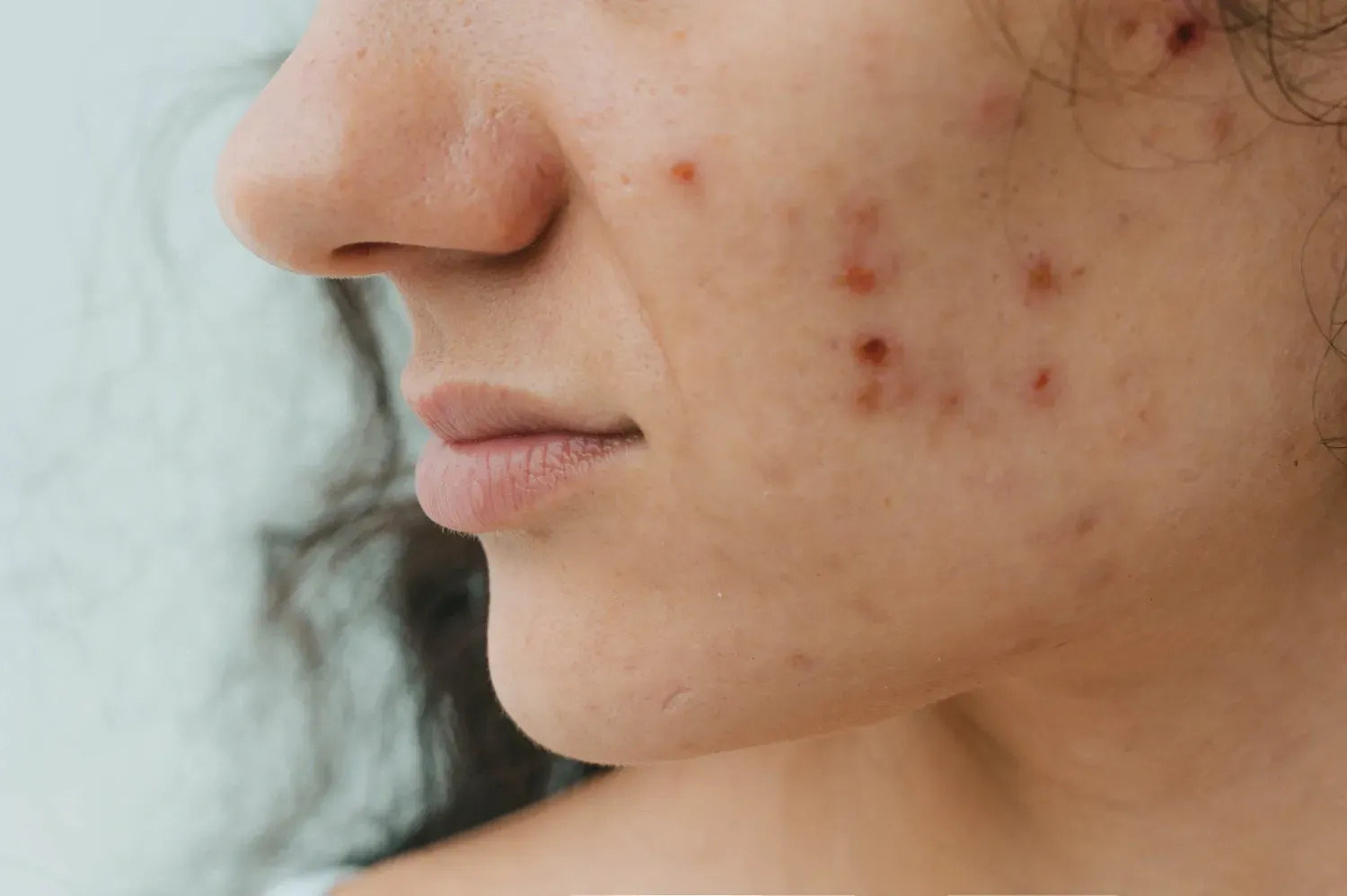 Primer plano de un rostro con imperfecciones de acné en la mejilla y la mandíbula.
