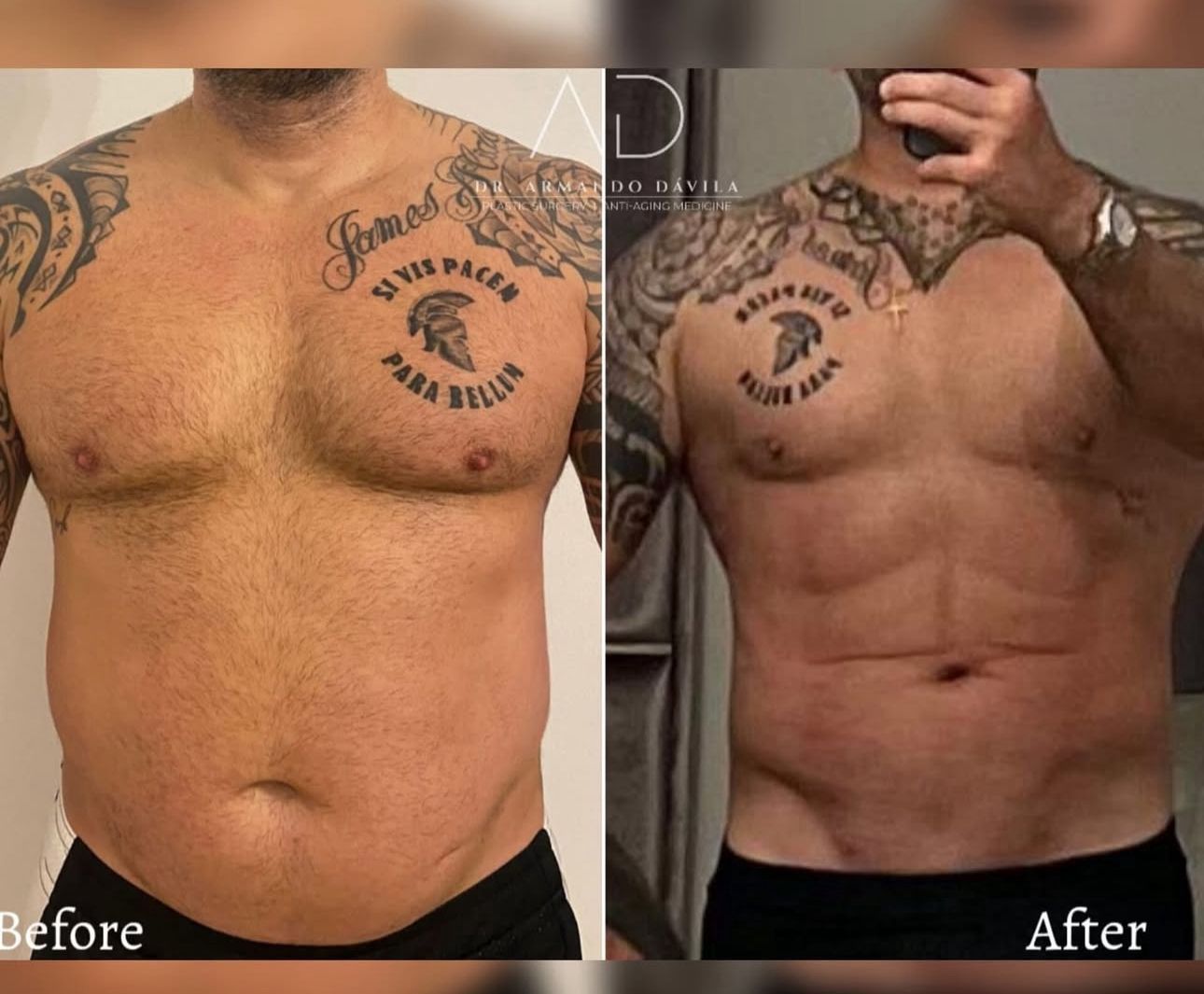 Fotografía del torso antes y después, que muestra la pérdida de peso y unos abdominales más definidos.