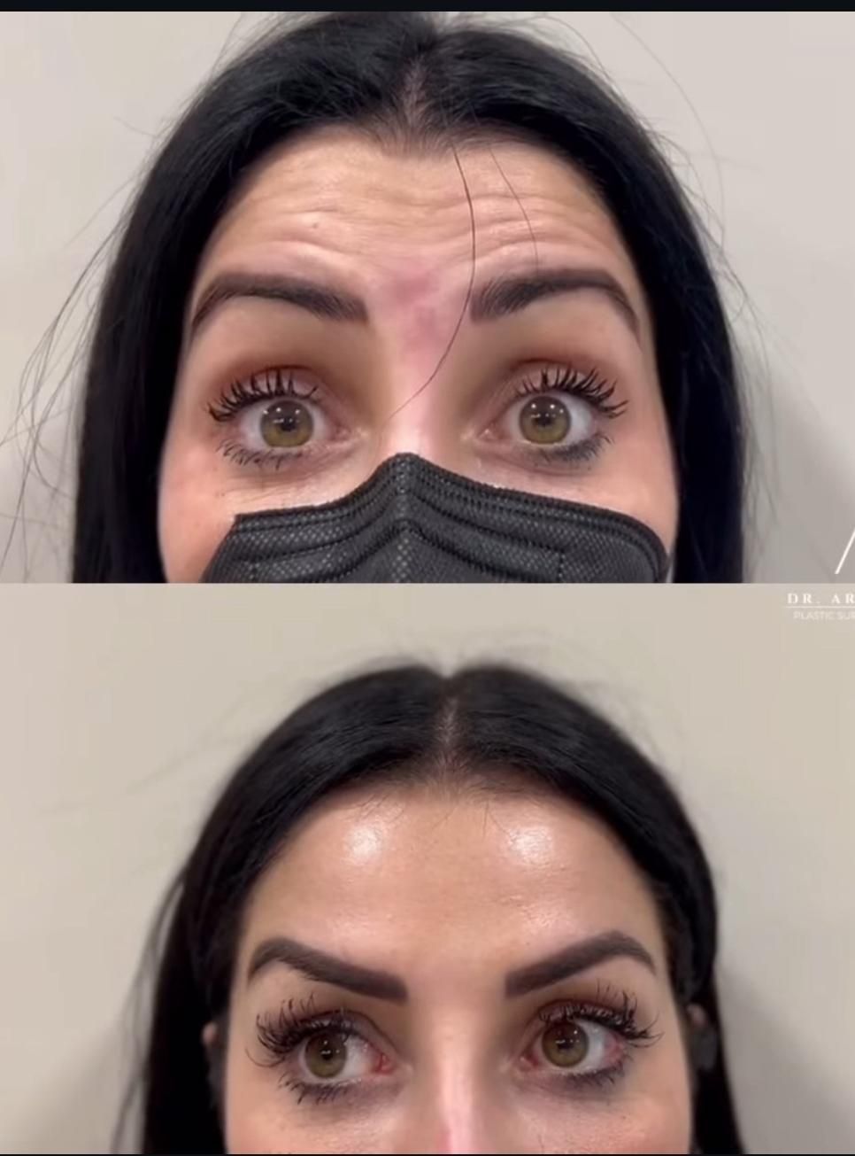 Primer plano de los ojos y la frente antes y después de un lifting de cejas, mostrando cejas elevadas y una piel más tersa.