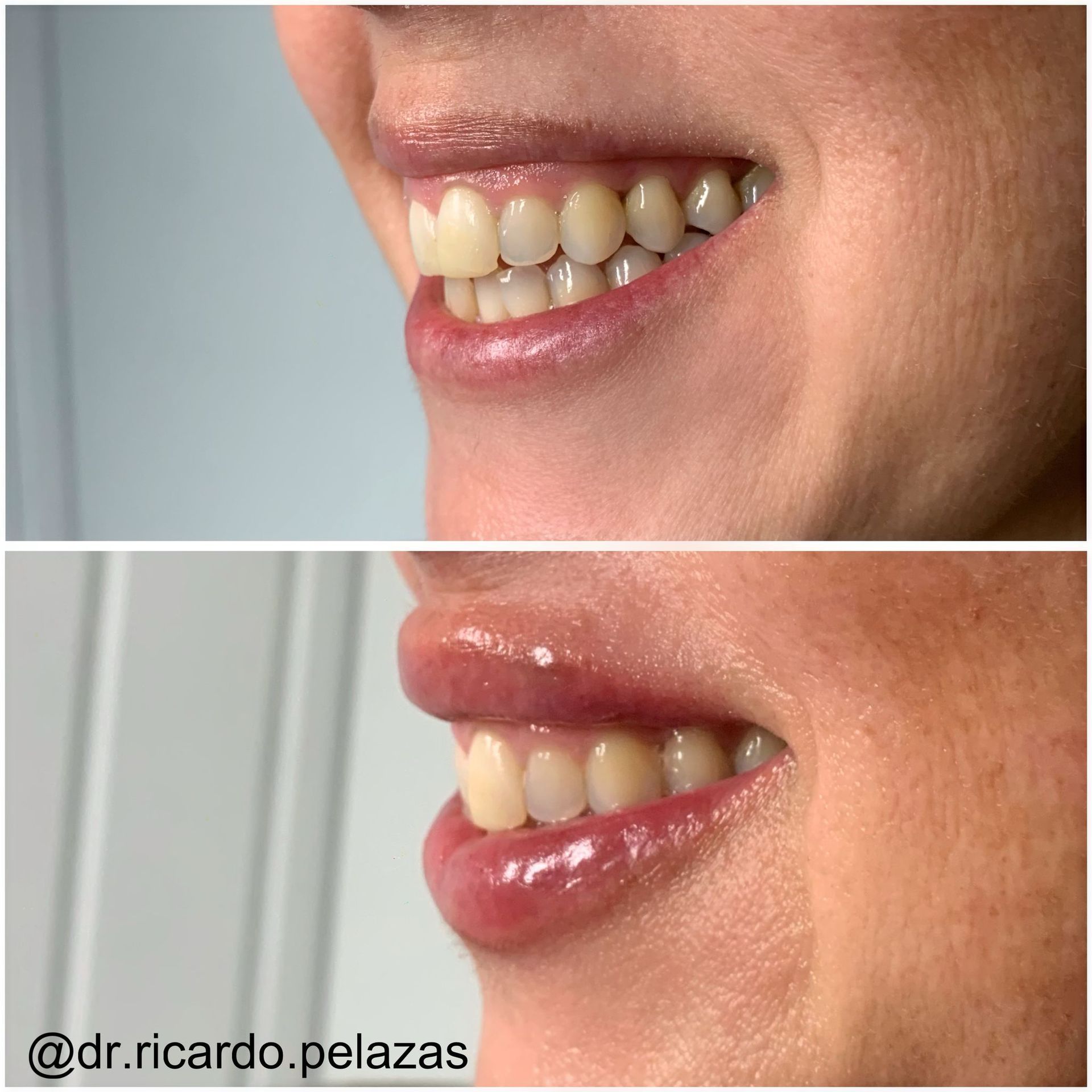 Primeros planos comparativos de una boca sonriente antes y después de un tratamiento dental estético.