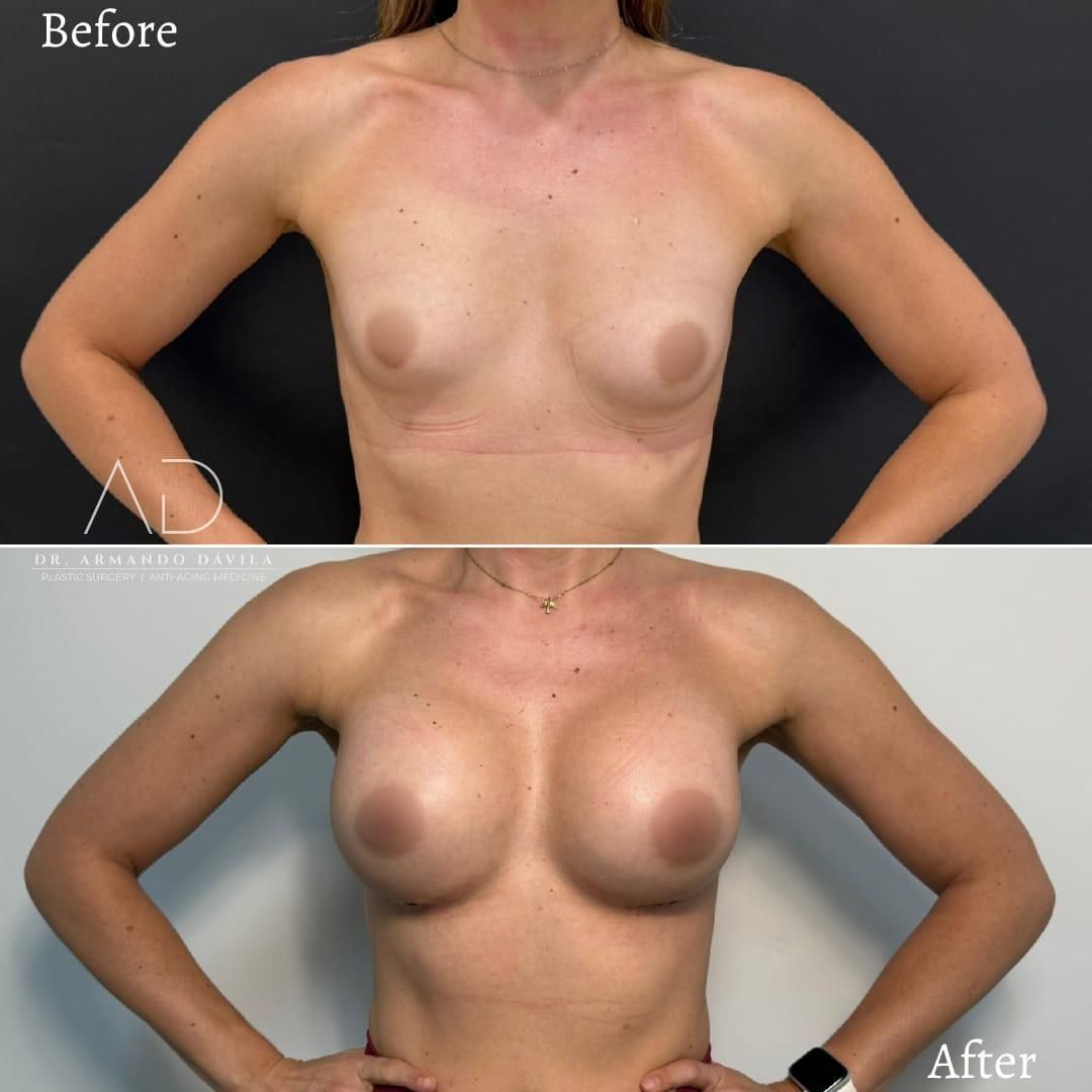 Comparación del antes y el después de un torso desnudo, que muestra senos más grandes después de la cirugía y un contorno de pecho alterado.