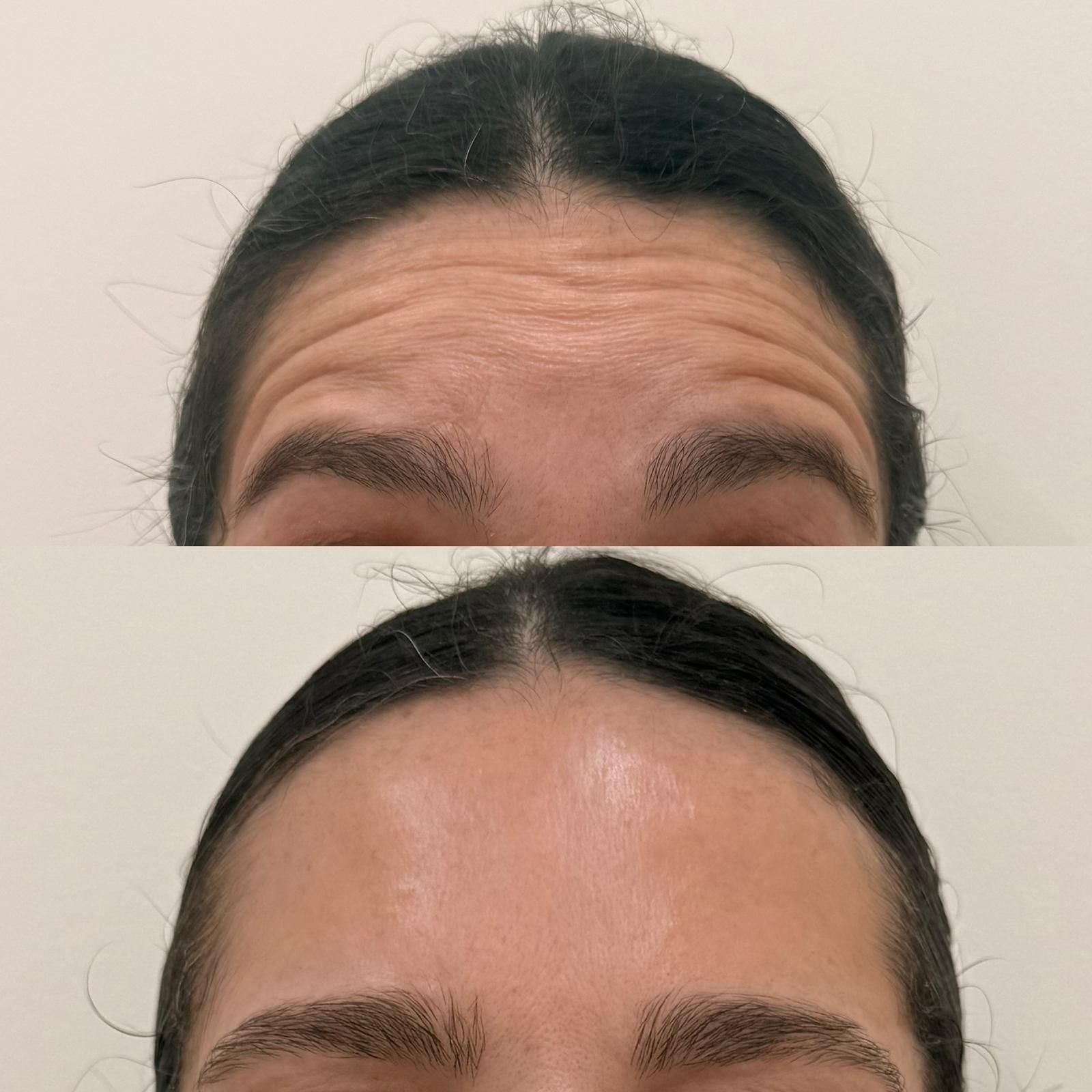 Primer plano de una frente con cabello oscuro recogido, antes y después de dar forma a las cejas.