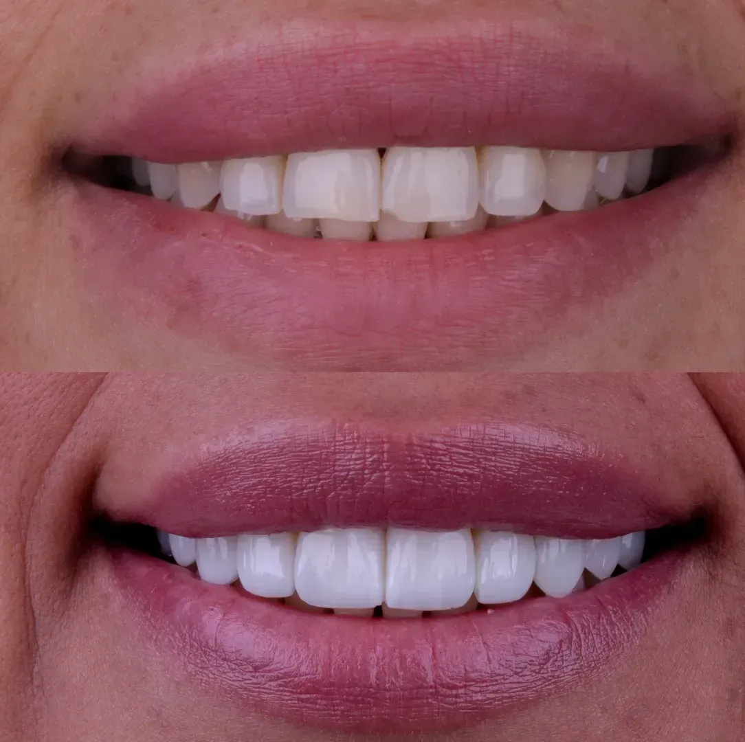 Una fotografía de antes y después de los dientes de una mujer.