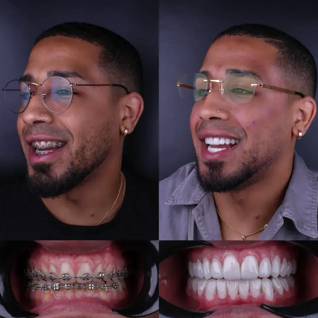 Un hombre que lleva gafas tiene aparatos dentales.