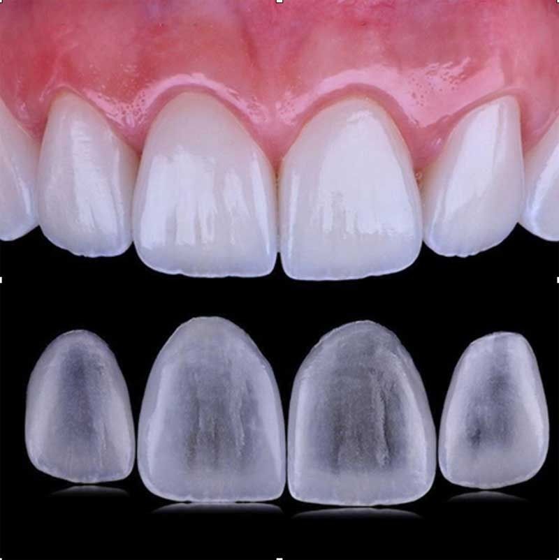 Un primer plano de los dientes de una persona con un fondo negro.