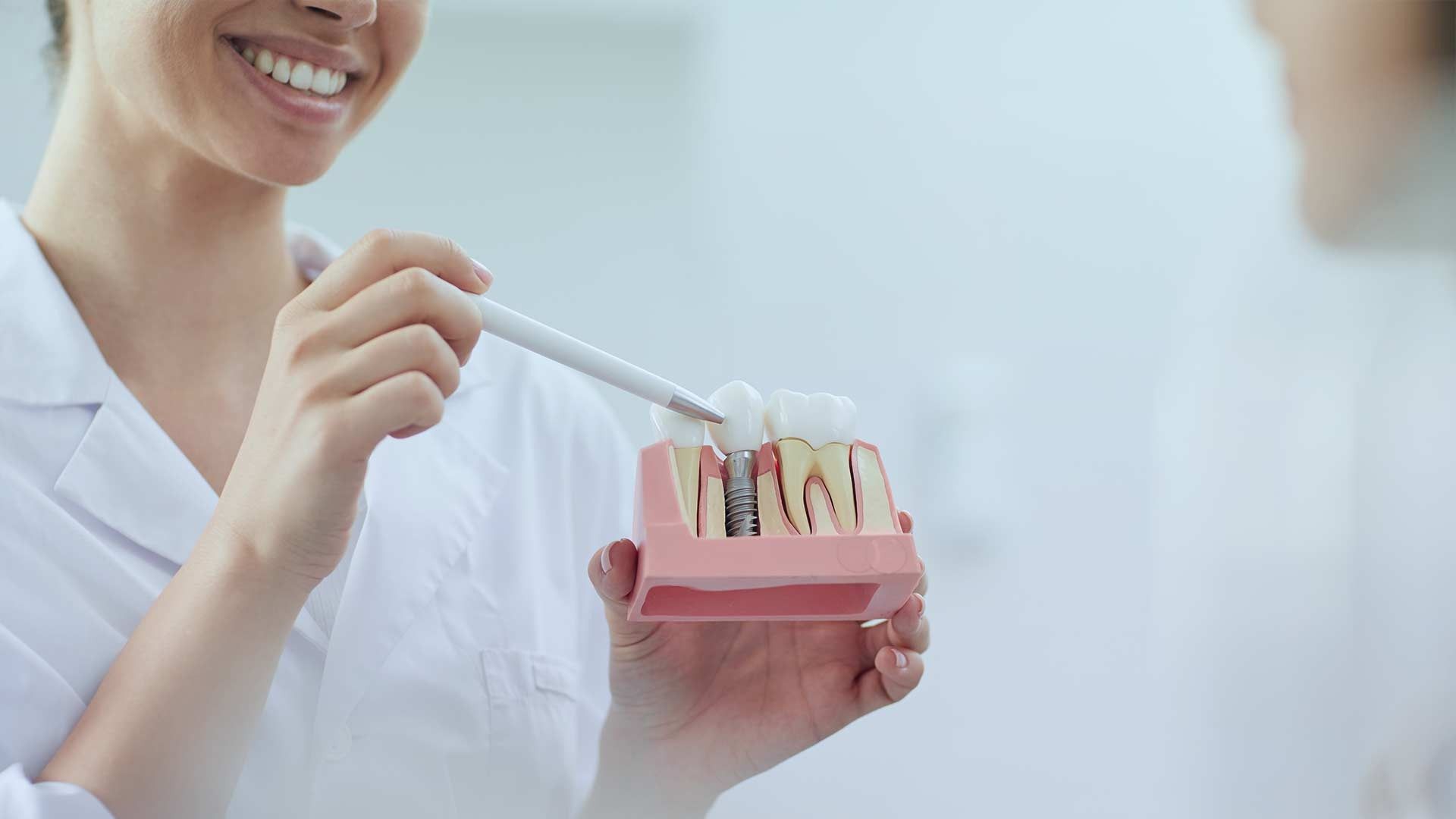 Un dentista sostiene un modelo de implantes dentales en su mano.
