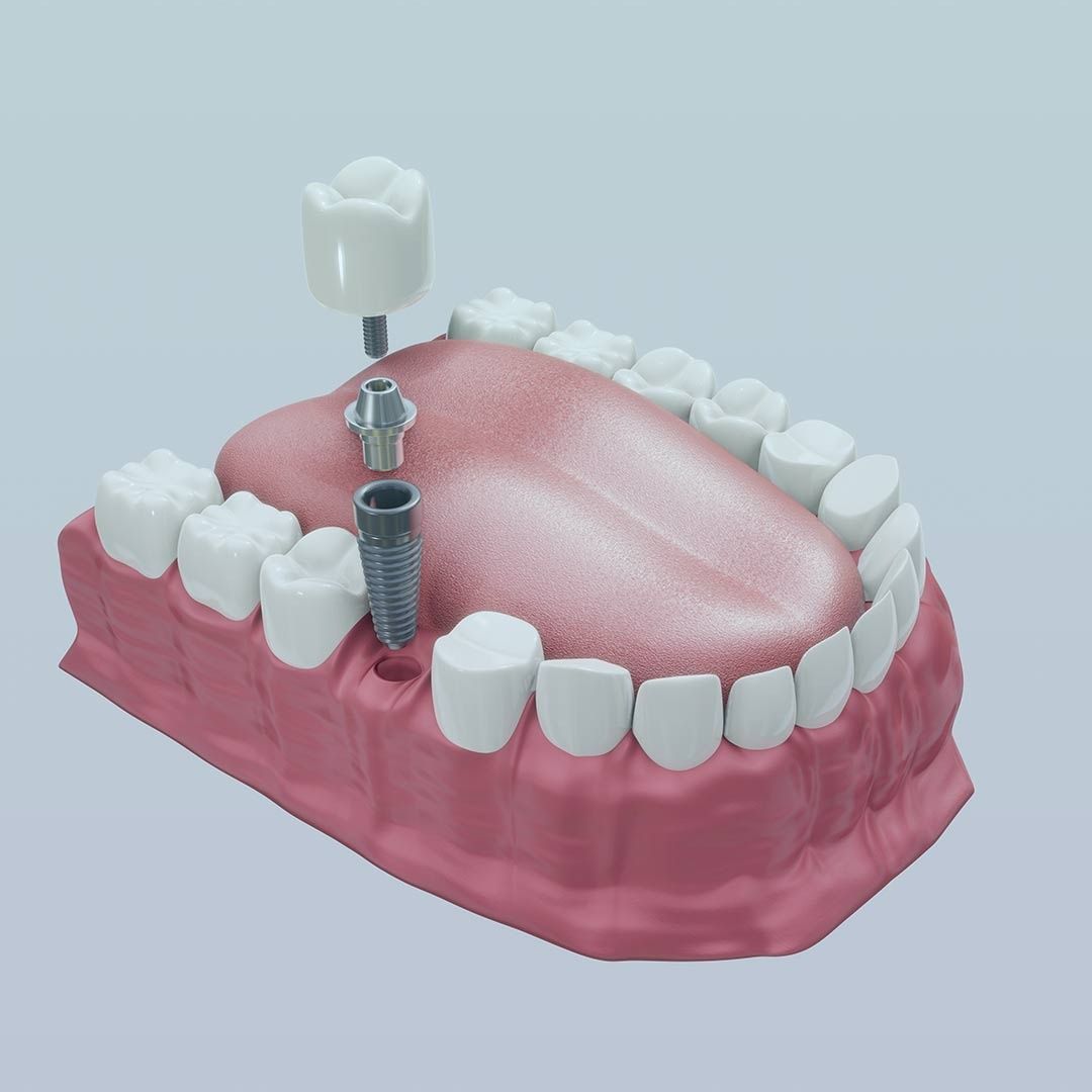 Un modelo de un diente con un implante dental.