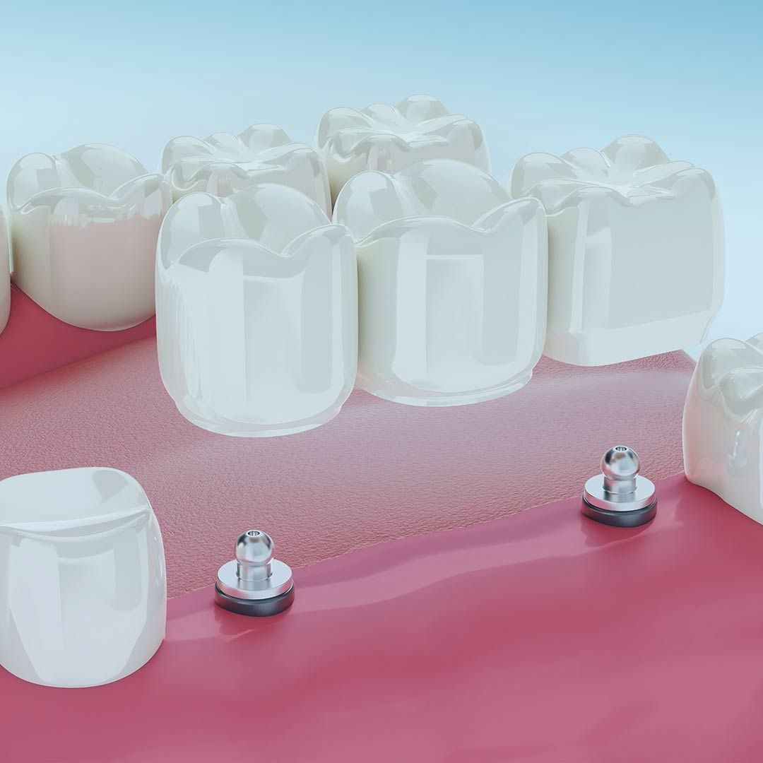 Un primer plano de un puente dental en la boca de una persona.