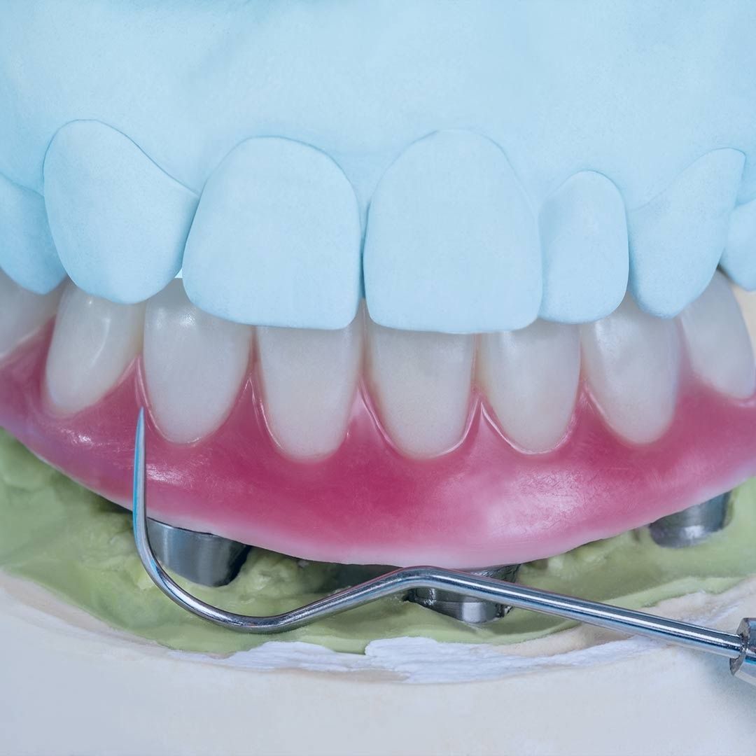 Un primer plano de una dentadura postiza con un tenedor en ella.