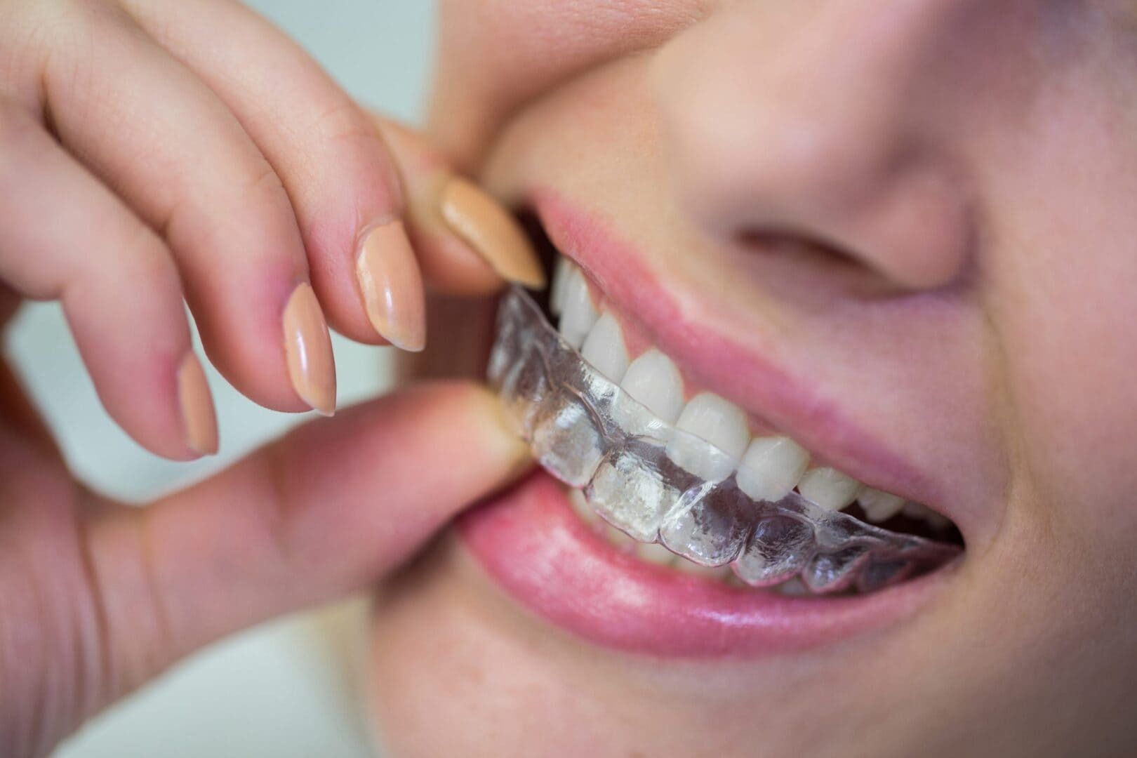 Una mujer se está colocando un aparato transparente en los dientes.