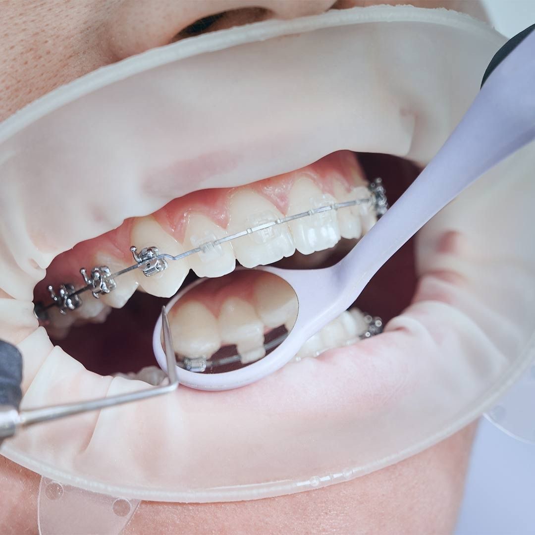 Una persona con brackets se cepilla los dientes con un cepillo de dientes.