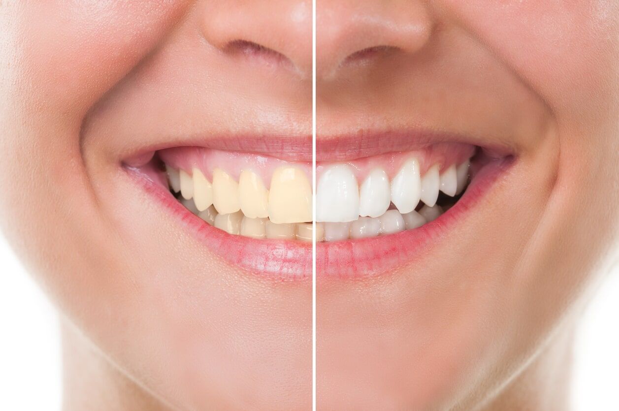 branqueamento dentário no Porto