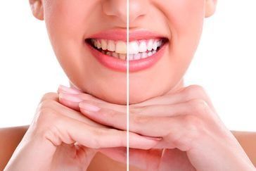 Una fotografía de antes y después de los dientes de una mujer.