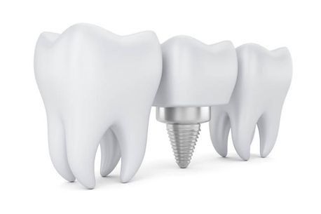 Una representación 3D de un implante dental entre dos dientes.