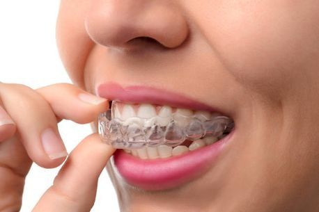 Una mujer se está colocando un aparato transparente en los dientes.