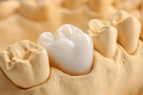 Un primer plano de un modelo de un diente con una corona dental sobre él.