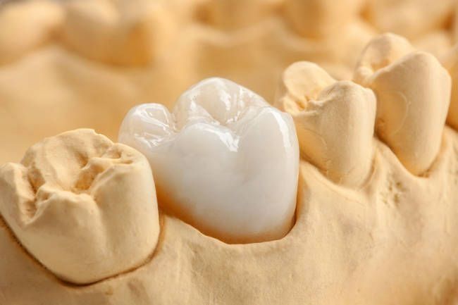 Un primer plano de un modelo de un diente con una corona dental sobre él.