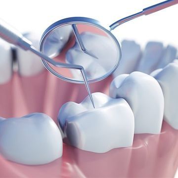 Un primer plano de un diente examinado por un dentista.