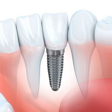 Una representación 3D de un implante dental entre dos dientes.
