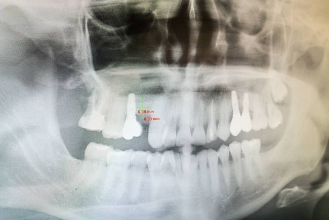 Una radiografía panorámica de los dientes y el cráneo de una persona.