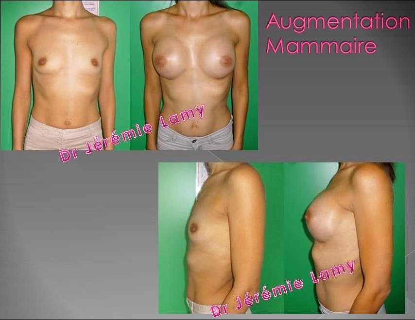Augmentation mammaire