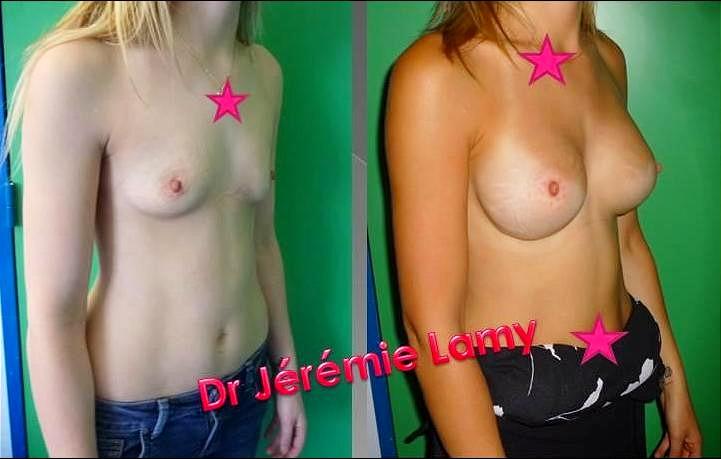 Implants mammaires