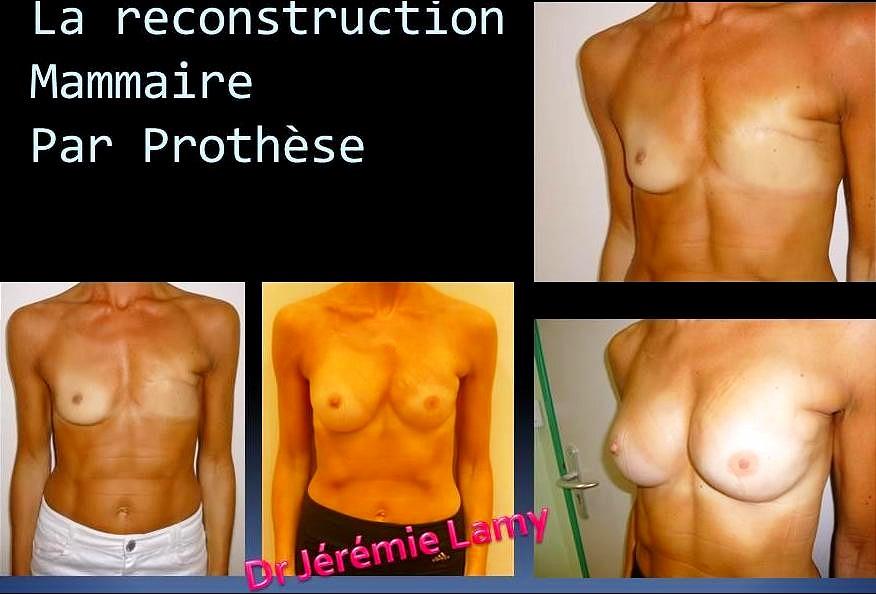 Reconstruction mammaire par prothèse