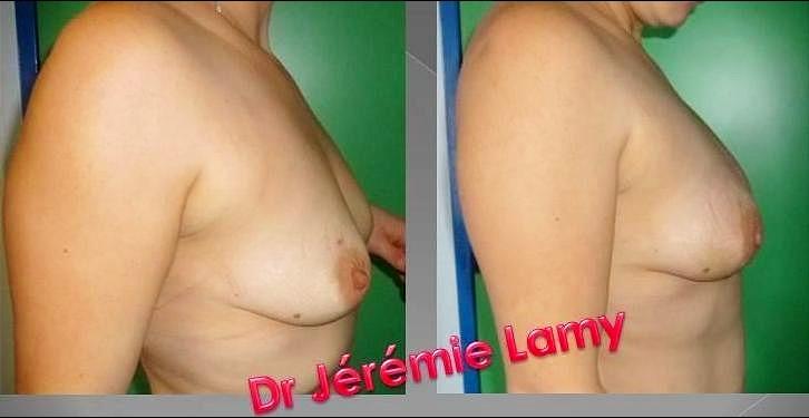 Augmentation mammaire par lipomodelage