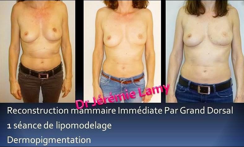 Grand dorsal sans implant - Reconstruction mammaire immédiate