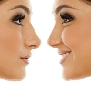 Geneva Central Clinic - rhinoplastie non invasive à base d'acide hyaluronique