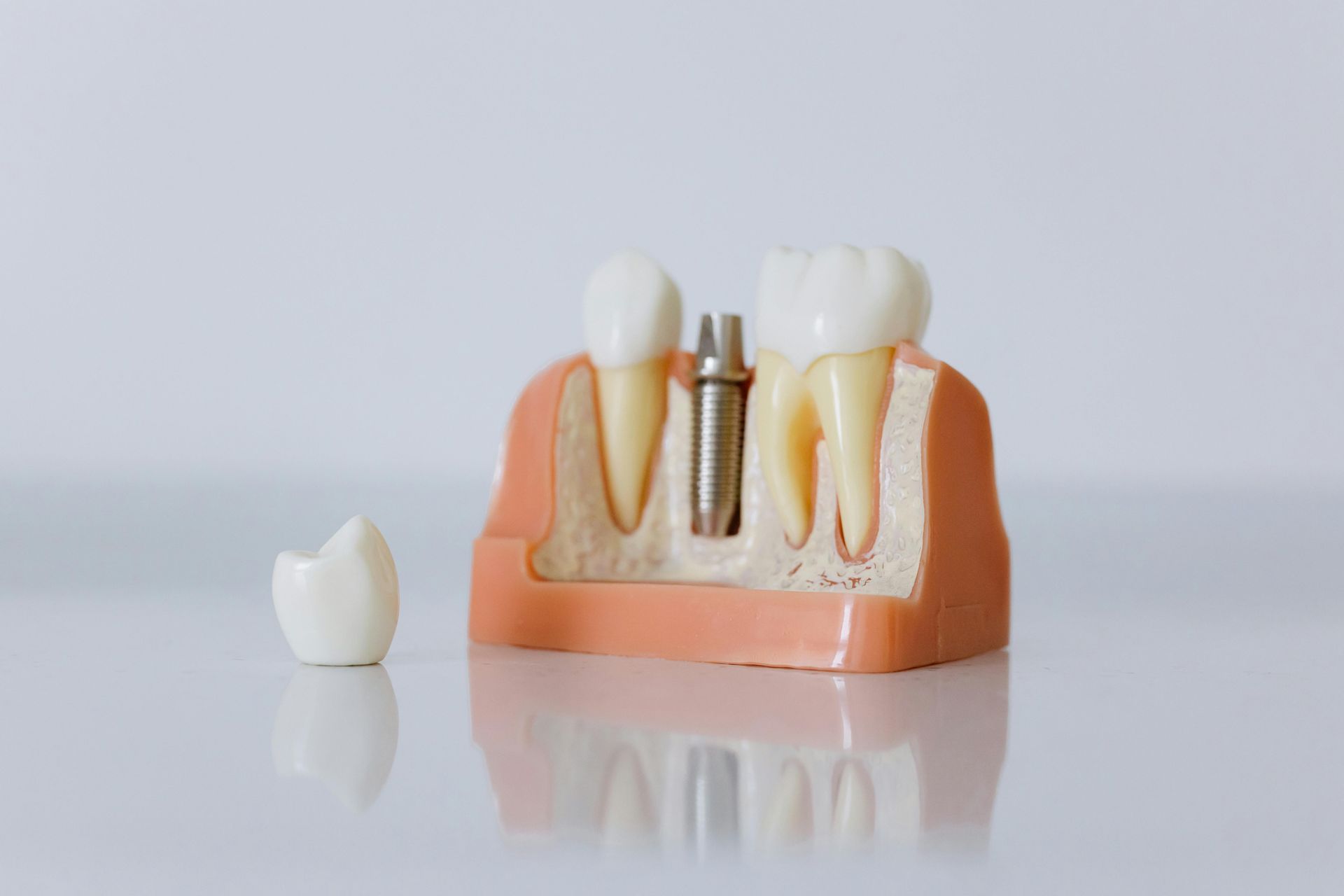 Modelo dental que muestra un poste de implante metálico entre dos dientes, con una corona dental separada en primer plano.
