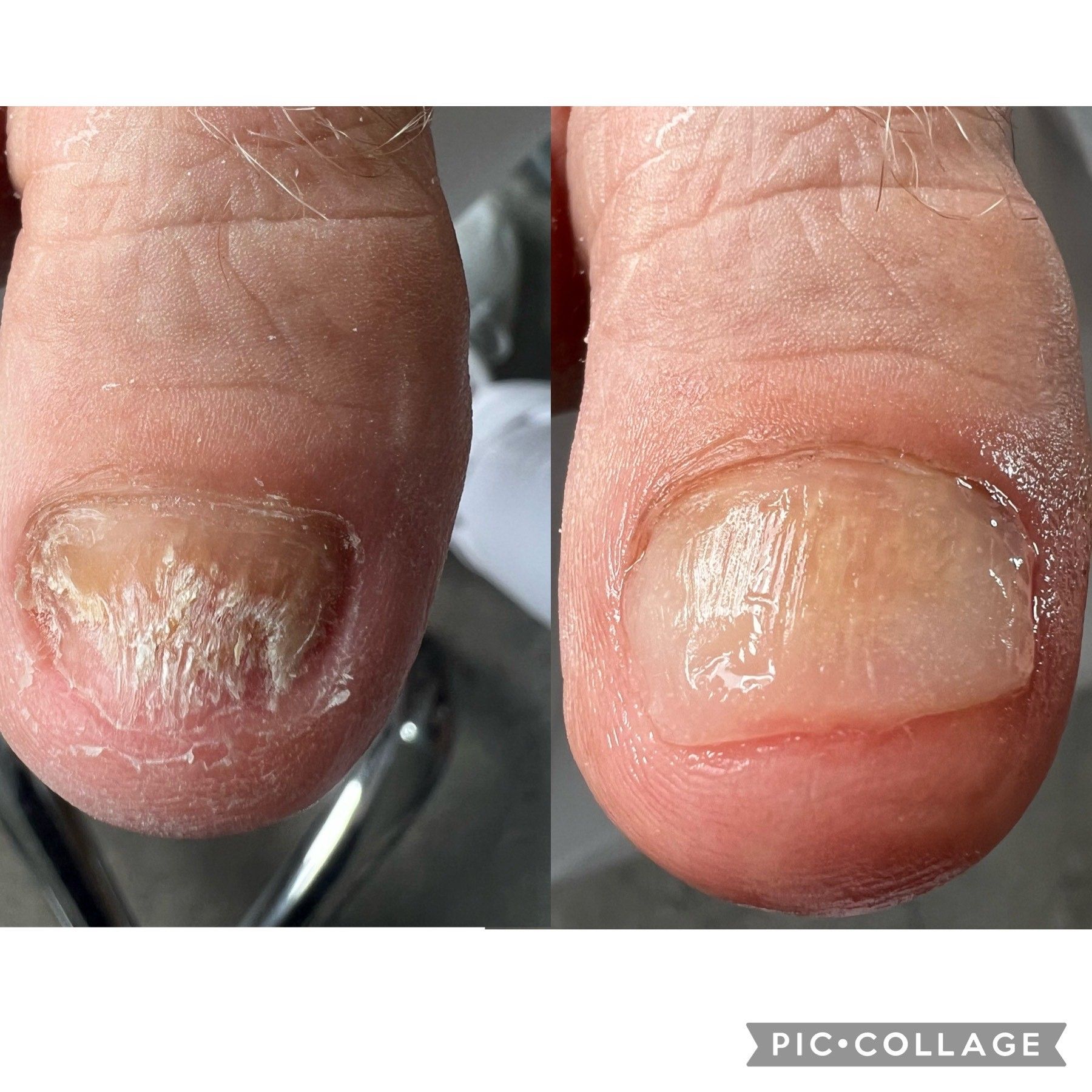 Nagelpilz vorher nachher