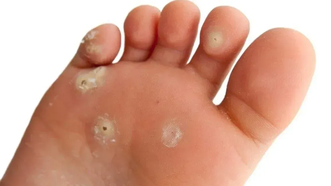 Vista de cerca de la planta del pie que muestra varias verrugas plantares con manchas oscuras centrales visibles.