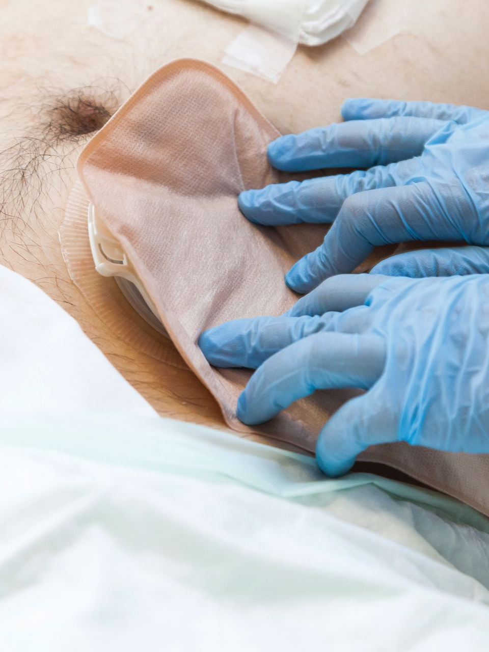 Des mains gantées de bleu appliquent un pansement sur l'abdomen d'un patient.