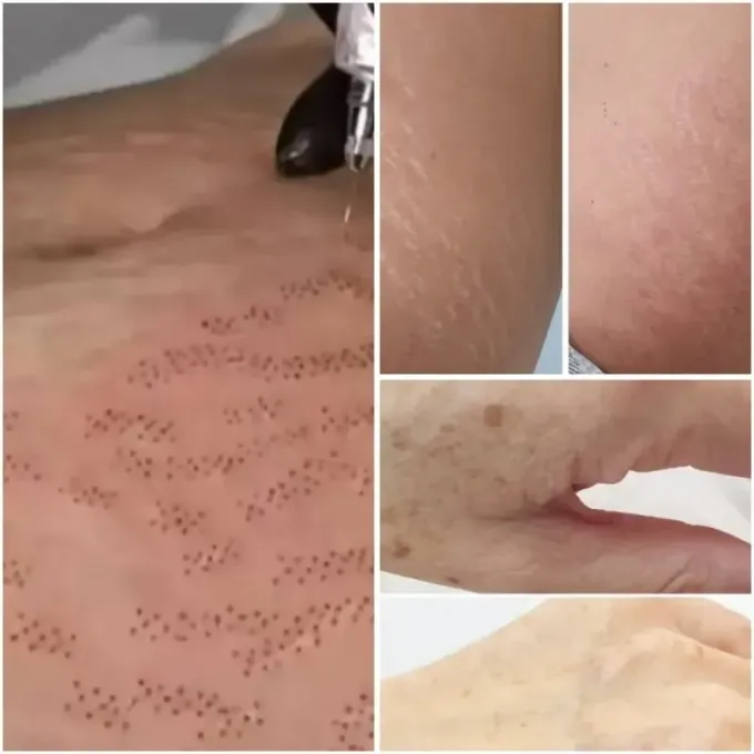 Comparación del antes y el después que muestra la zona inferior del rostro y el cuello