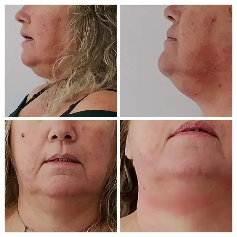 Comparación del antes y el después del contorno de la mandíbula de una persona, que muestra una reducción del volumen