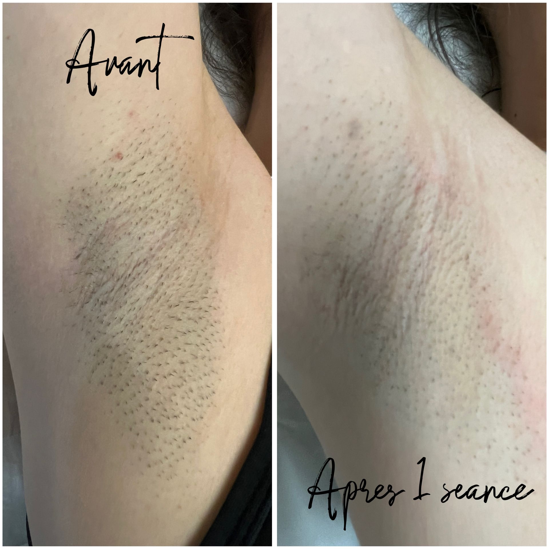 Dermopigmentation correctrice